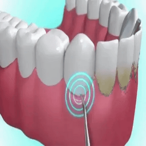 Teeth Cleaner™ Tannsteinfjerner med 5 nivåer - tekshop.no