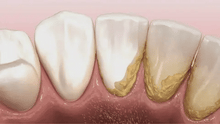 Load image into Gallery viewer, Teeth Cleaner™ Tannsteinfjerner med 5 nivåer - tekshop.no